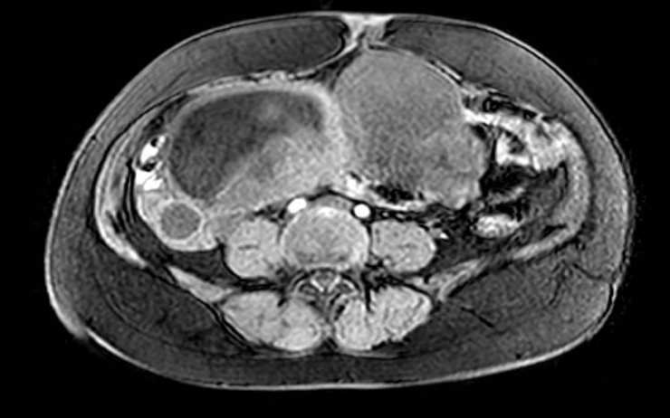 Colon adenocarcinoma with Krukenberg tumors, advanced pregnancy (Radiopaedia 67279-76645 A 35).jpg