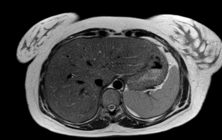 File:Colon adenocarcinoma with Krukenberg tumors, advanced pregnancy (Radiopaedia 67279-76645 Axial T2 71).jpg