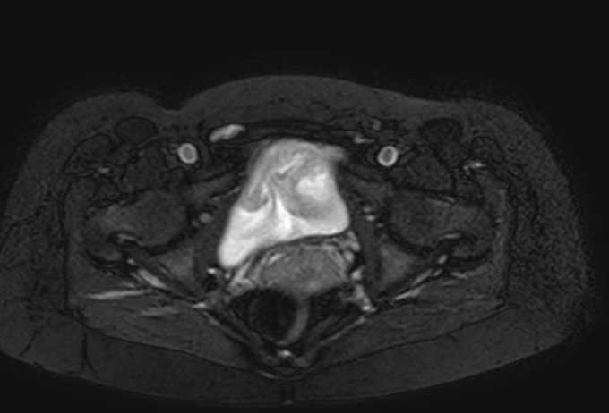 Colon adenocarcinoma with Krukenberg tumors, advanced pregnancy (Radiopaedia 67279-76645 Axial T2 SPAIR 6).jpg