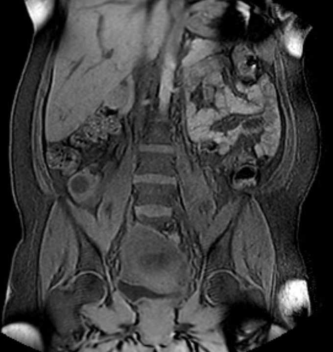 Colon adenocarcinoma with Krukenberg tumors, advanced pregnancy (Radiopaedia 67279-76645 E 51).jpg