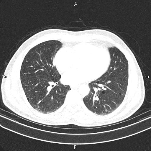File:Colon cancer (Radiopaedia 85663-101443 Axial lung window 40).jpg