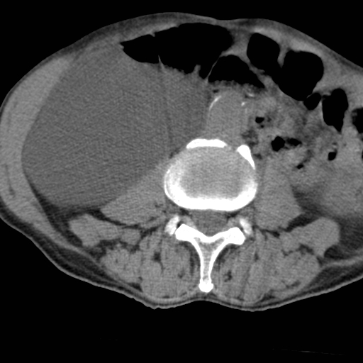 Colon cancer with calcified liver metastasis (Radiopaedia 74423-85309 Axial non-contrast 55).jpg