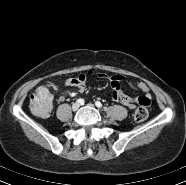 Colon carcinoma with hepatic metastases (Radiopaedia 29477-29961 A 75).jpg