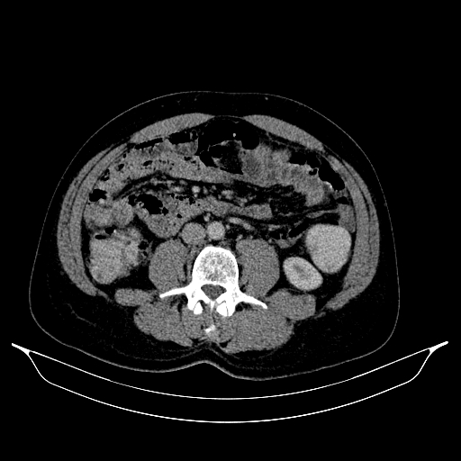 Colonic diverticulosis (Radiopaedia 72222-82744 A 32).jpg