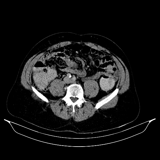 Colonic diverticulosis (Radiopaedia 72222-82744 A 65).jpg