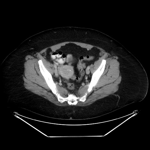 File:Colonic intussusception due to adenocarcinoma (Radiopaedia 86828-102987 A 124).jpg