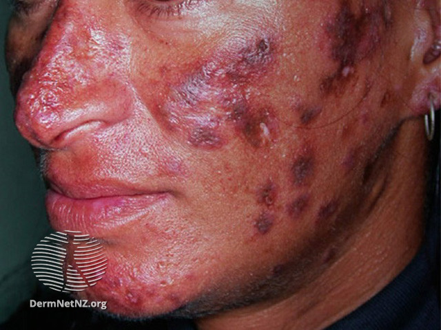 Cutaneous lupus erythematosus (DermNet NZ immune-lupus-erythematosus-2557).jpg