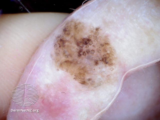 File:Melanoma in situ, polarised dermoscopy view (DermNet NZ 20131127111916099).jpg