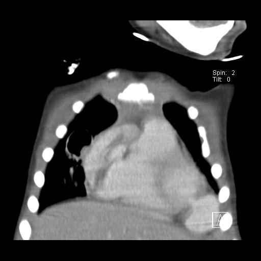File:Mycotic aneurysm of the left ventricle (Radiopaedia 13799).JPG