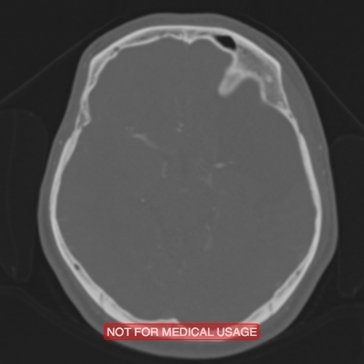 Nasopharyngeal carcinoma recurrence - skull base destruction (Radiopaedia 29107-29490 Axial bone window 60).jpg