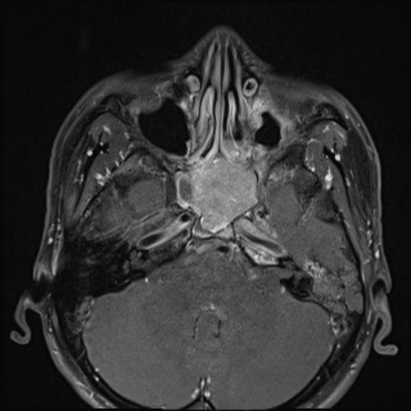 Nasopharyngeal carcinoma with skull base invasion (Radiopaedia 53415-59485 Axial T1 C+ fat sat 21).jpg