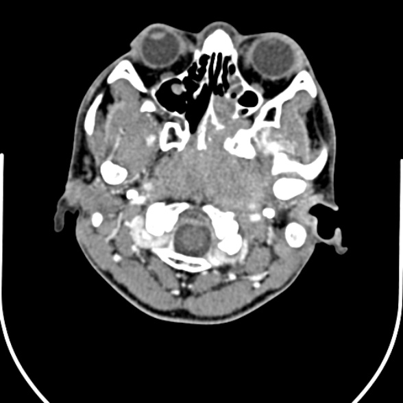 File:Nasopharyngeal carcinoma with skull base invasion (Radiopaedia 53415-59705 A 34).jpg
