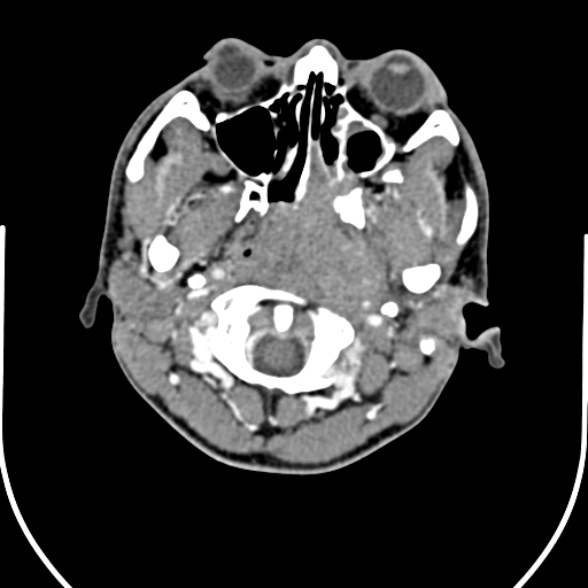 Nasopharyngeal carcinoma with skull base invasion (Radiopaedia 53415-59705 A 39).jpg