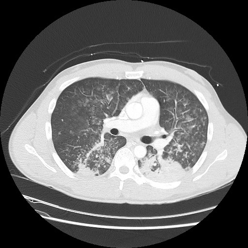 Near-drowning pulmonary edema (Radiopaedia 59457-66814 Axial lung window 27).jpg