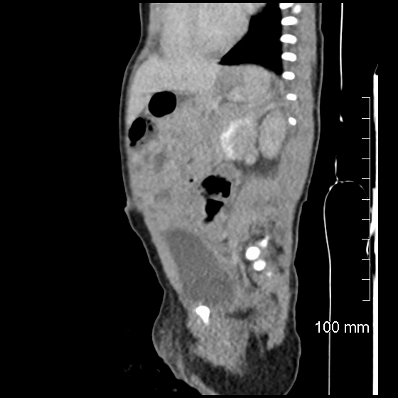 File:Neonatal neuroblastoma (Radiopaedia 56651-63438 C 38).jpg