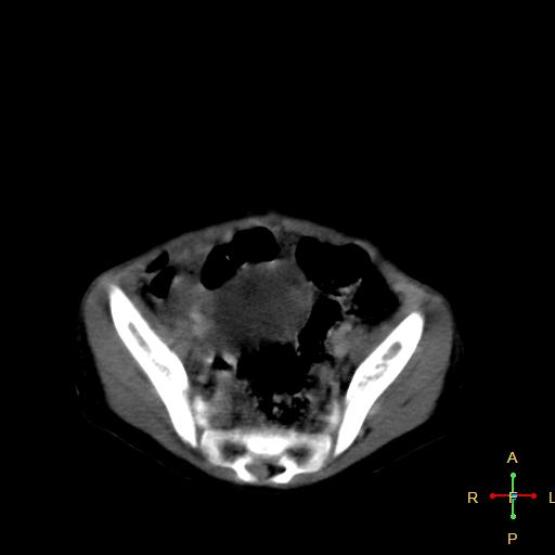 File:Neuroblastoma (Radiopaedia 24751-25016 D 35).jpg