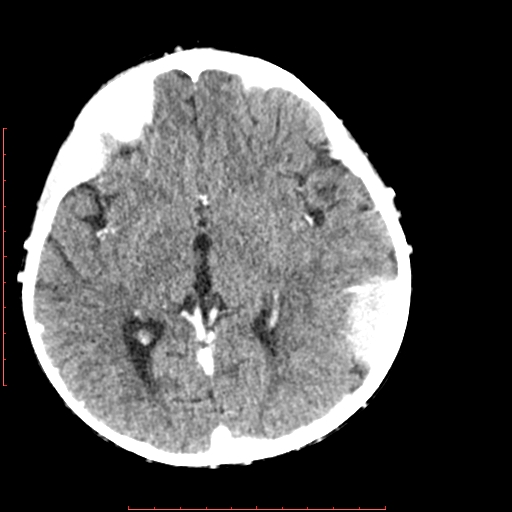 File:Neuroblastoma skull metastasis (Radiopaedia 56053-62683 Axial +Contrast 9).jpg