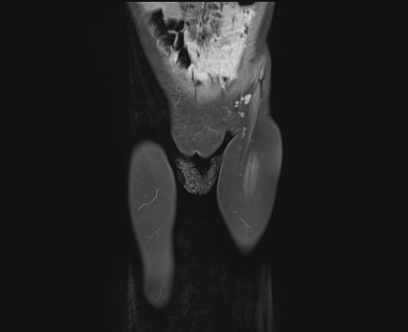 File:Neuroblastoma with bone metastases (Radiopaedia 67080-76414 E 2).jpg