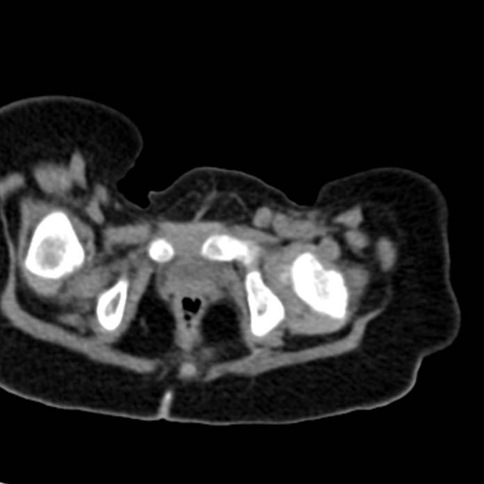 Neuroblastoma with skull metastases (Radiopaedia 30326-30960 Axial non-contrast 62).jpg