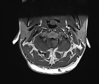 File:Neurofibromatosis type 1 (Radiopaedia 80355-93740 Axial T1 7).jpg