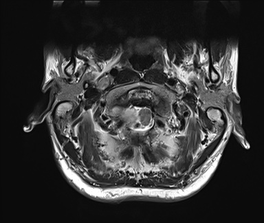 File:Neurofibromatosis type 1 (Radiopaedia 80355-93740 Axial T2 2).jpg
