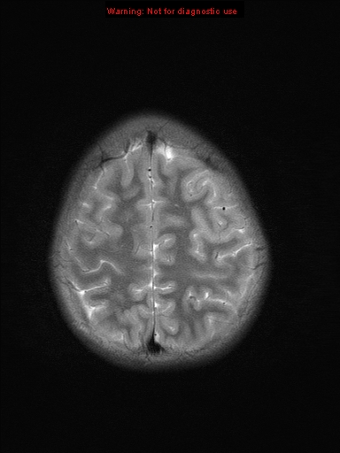 File:Neurofibromatosis type 1 with optic nerve glioma (Radiopaedia 16288-15965 Axial T2 5).jpg