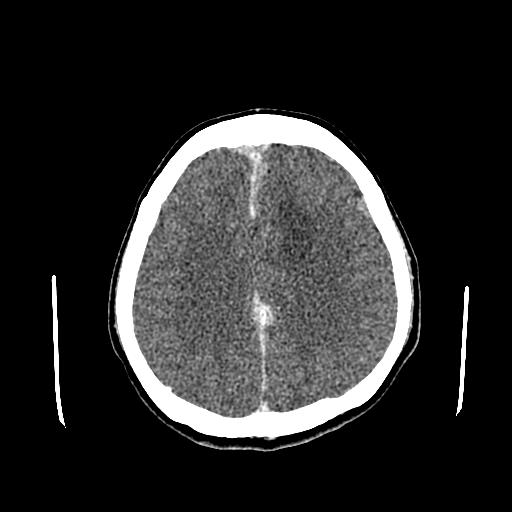 File:Neurofibromatosis type 2 (Radiopaedia 25389-25637 Axial C+ 68).jpg