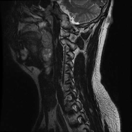 File:Neurofibromatosis type 2 (Radiopaedia 44936-48837 Sagittal T2 5).png