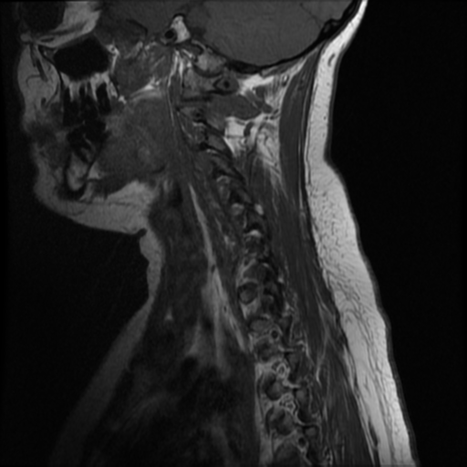 File:Neurofibromatosis type 2 (Radiopaedia 45229-49252 Sagittal T1 3).png