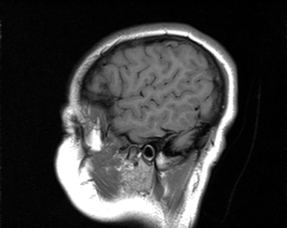 File:Neurofibromatosis type 2 (Radiopaedia 66211-75401 Sagittal T1 22).jpg