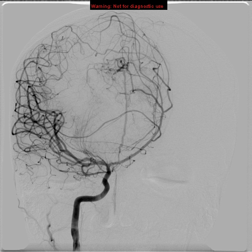 File:Neurofibromatosis type 2 (Radiopaedia 8953-9733 D 7).jpg