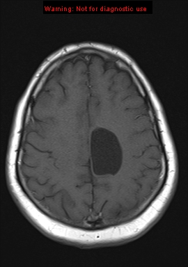 File:Neuroglial cyst (Radiopaedia 10713-11184 Axial T1 6).jpg