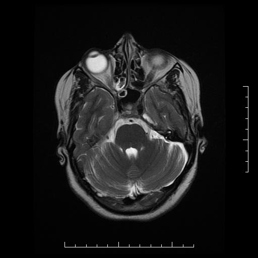 File:Neuroglial cyst of brainstem (Radiopaedia 29134-29526 Axial T2 6).jpg