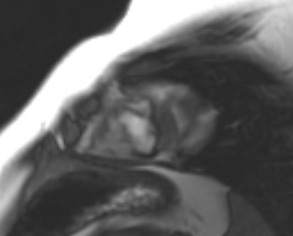 File:Non-compaction of the left ventricle (Radiopaedia 69436-79314 Short axis cine 21).jpg