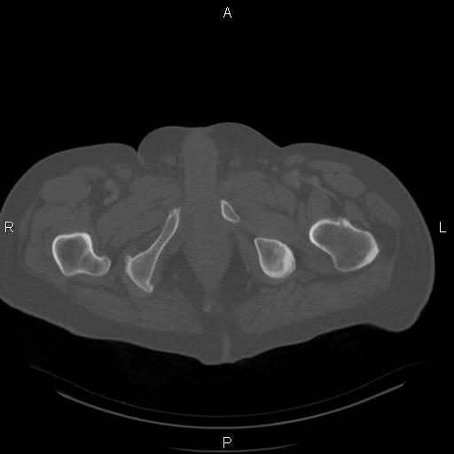 Non Hodgkin lymphoma in a patient with ankylosing spondylitis (Radiopaedia 84323-99624 Axial bone window 68).jpg