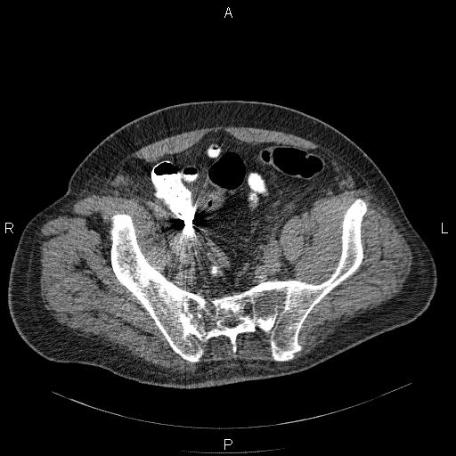 File:Non Hodgkin lymphoma in a patient with ankylosing spondylitis (Radiopaedia 84323-99624 Axial non-contrast 56).jpg