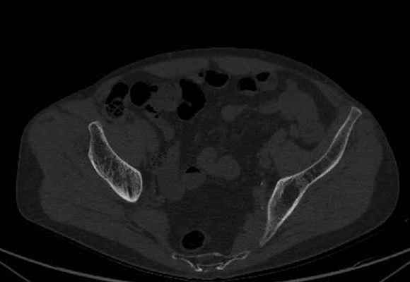 File:Nondisplaced incomplete intertrochanteric fracture (Radiopaedia 73736-84539 Axial bone window 7).jpg