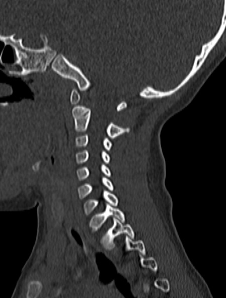 File:Normal CT cervical spine - pediatric (Radiopaedia 52549-58462 Sagittal bone window 142).jpg