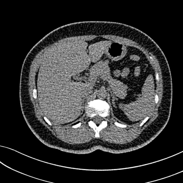 Normal CT chest- adult female (Radiopaedia 52522-58428 Axial non-contrast 134).jpg