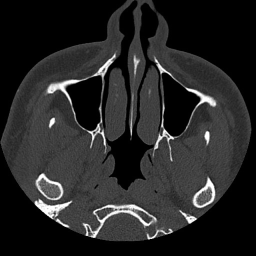 Normal CT paranasal sinuses (Radiopaedia 42286-45390 Axial bone window 85).jpg
