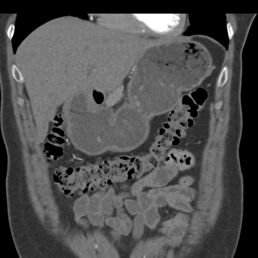File:Normal CT renal artery angiogram (Radiopaedia 38727-40889 B 23).png