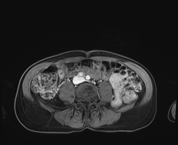 Normal adrenal glands MRI (Radiopaedia 82017-96004 K 68).jpg