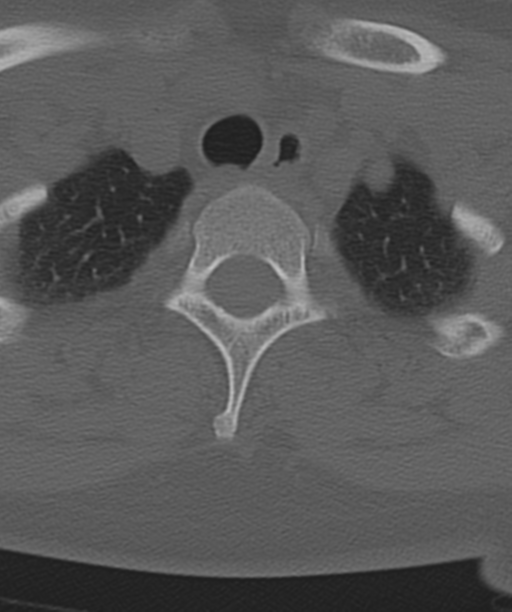 Normal cervical spine MRI (including Dixon) (Radiopaedia 42762-45926 Axial bone window 55).png