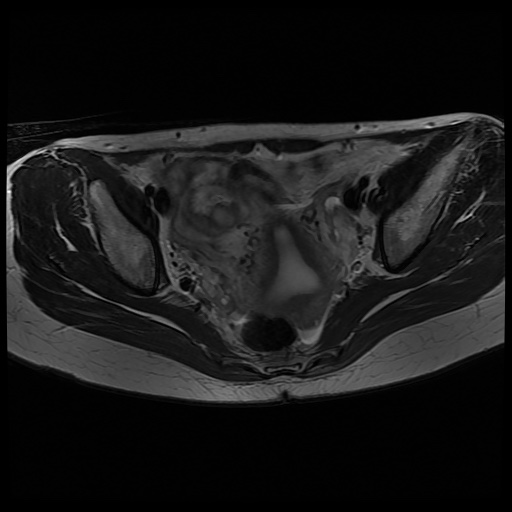 File:Normal female pelvis MRI (retroverted uterus) (Radiopaedia 61832-69933 Axial T2 16).jpg