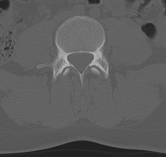 File:Normal lumbar spine CT (Radiopaedia 46533-50986 Axial bone window 45).png
