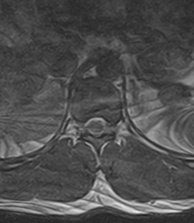 Normal lumbar spine MRI - low-field MRI scanner (Radiopaedia 40976-43699 Axial T2 3).jpg