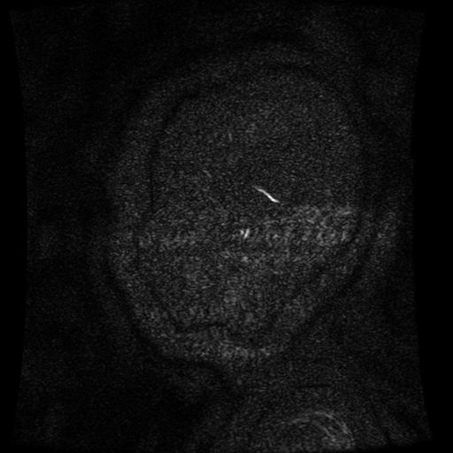 Normal noncontrast MR venography (Radiopaedia 87578-103957 A 2).jpg