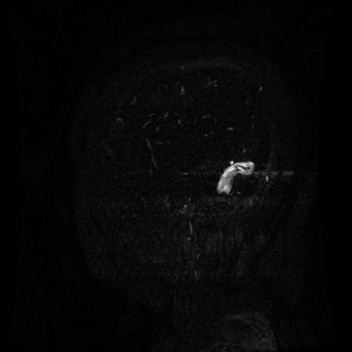 Normal noncontrast MR venography (Radiopaedia 87578-103957 A 20).jpg