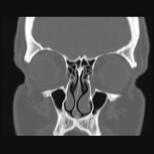 Normal sinus CT (annotated) (Radiopaedia 78917-91810 Coronal bone window 21).jpg