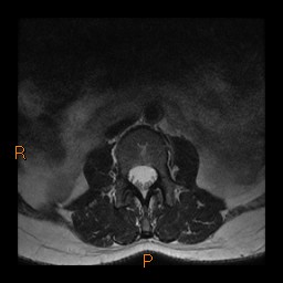 File:Normal spine MRI (Radiopaedia 77323-89408 Axial T2 2).jpg